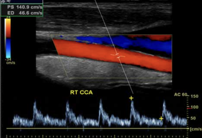 Ecografia Doppler